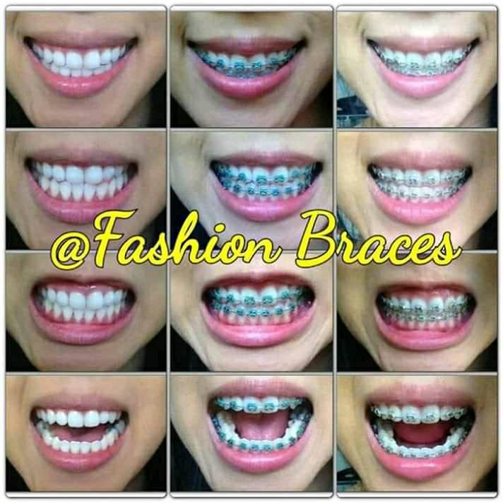 fashion braces in jamaica cost